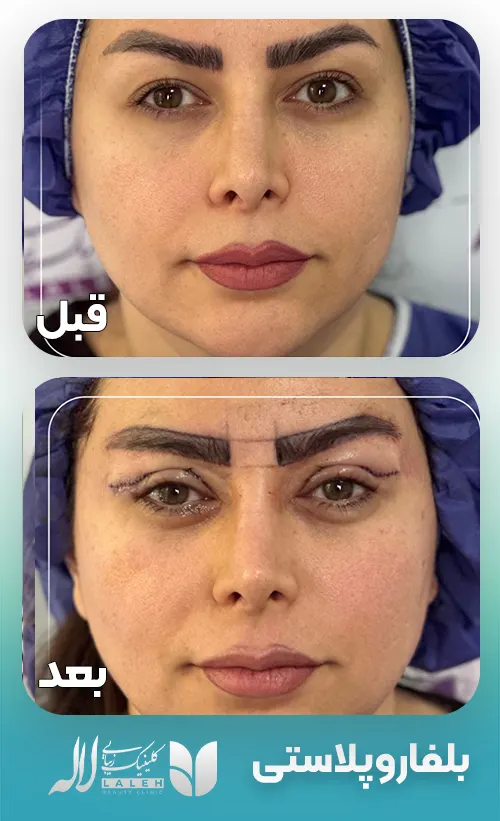 قبل و بعد بلفاروپلاستی