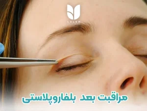 مراقبت های مهم بعد عمل بلفاروپلاستی