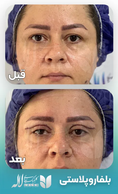 قبل و بعد بلفاروپلاستی
