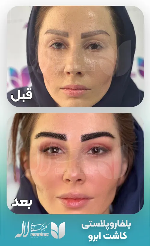 بلفاروپلاستی