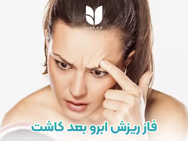 فاز ریزش ابرو بعد کاشت
