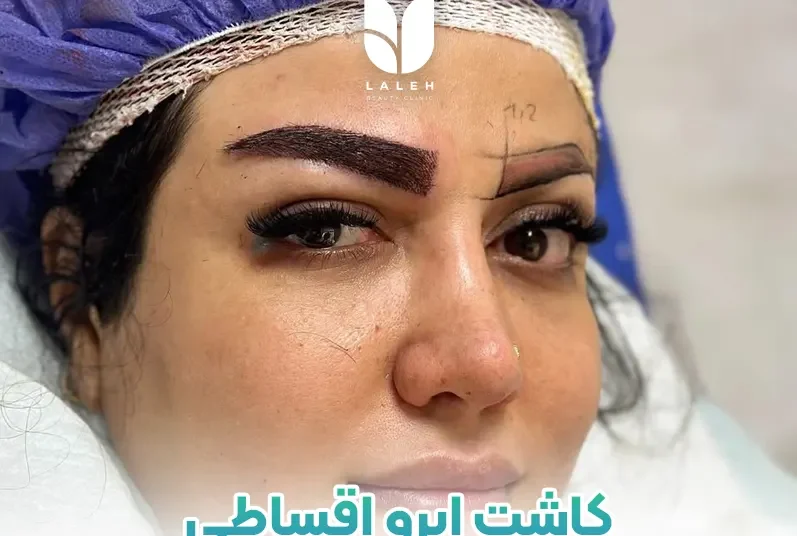 کاشت ابرو اقساطی