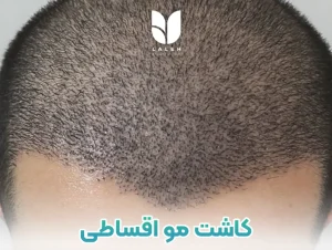 کاشت مو اقساطی تهران