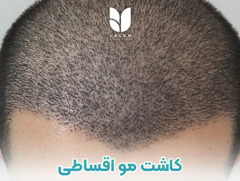 کاشت مو اقساطی تهران