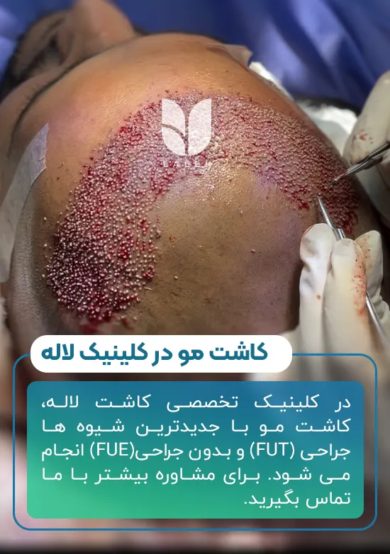 کاشت مو