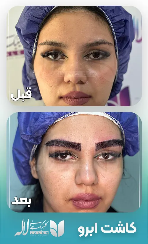 کاشت ابرو در لاله