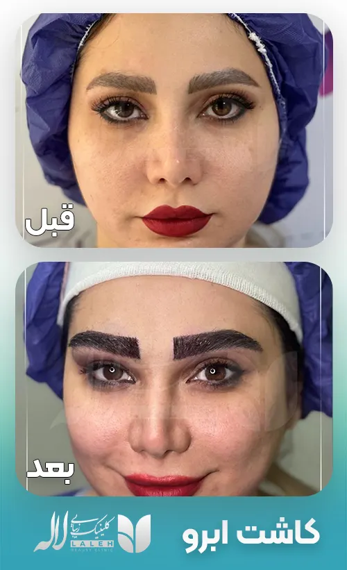 کاشت ابرو لاله