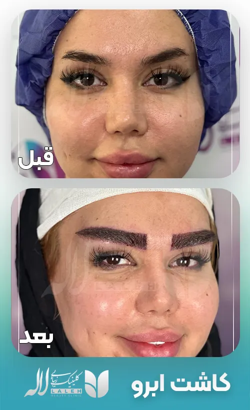 قبل و بعد کاشت ابرو