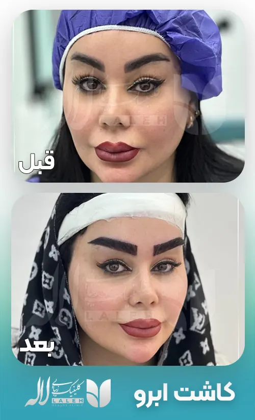 قبل و بعد کاشت ابرو