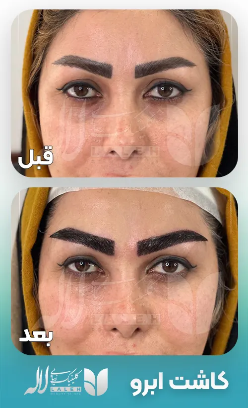 کاشت ابرو