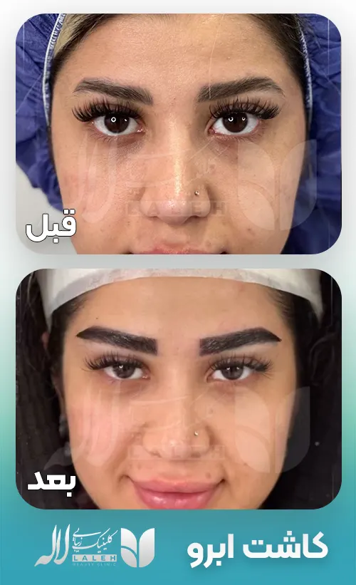 کاشت ابرو