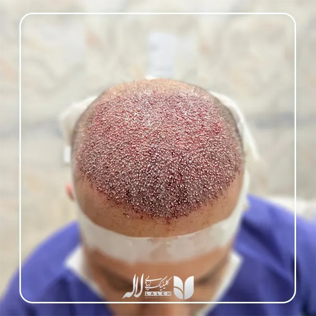 کاشت مو اقساطی