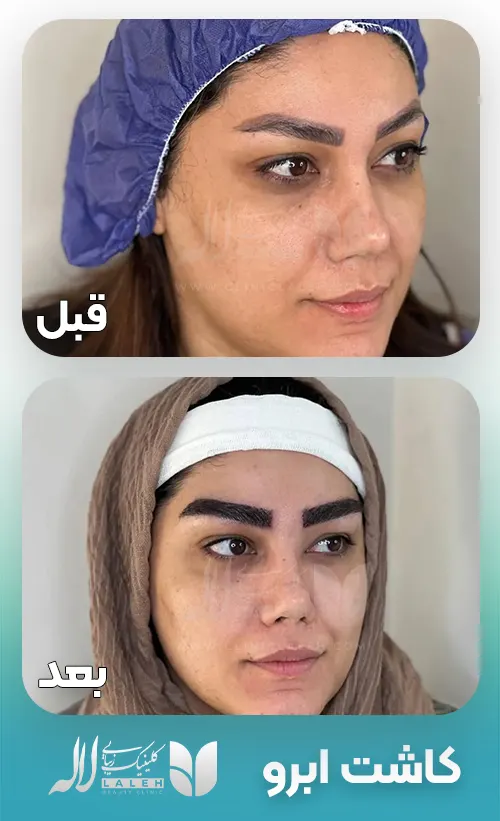کاور تاتو ابرو با کاشت ابرو