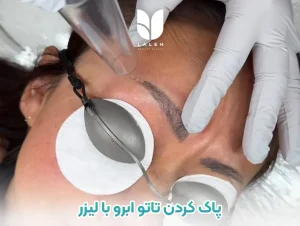 پاک کردن تاتو ابرو با لیزر