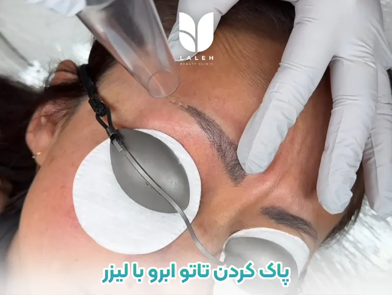 پاک کردن تاتو ابرو با لیزر