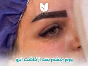 کبودی و ورم چشم بعد از کاشت ابرو