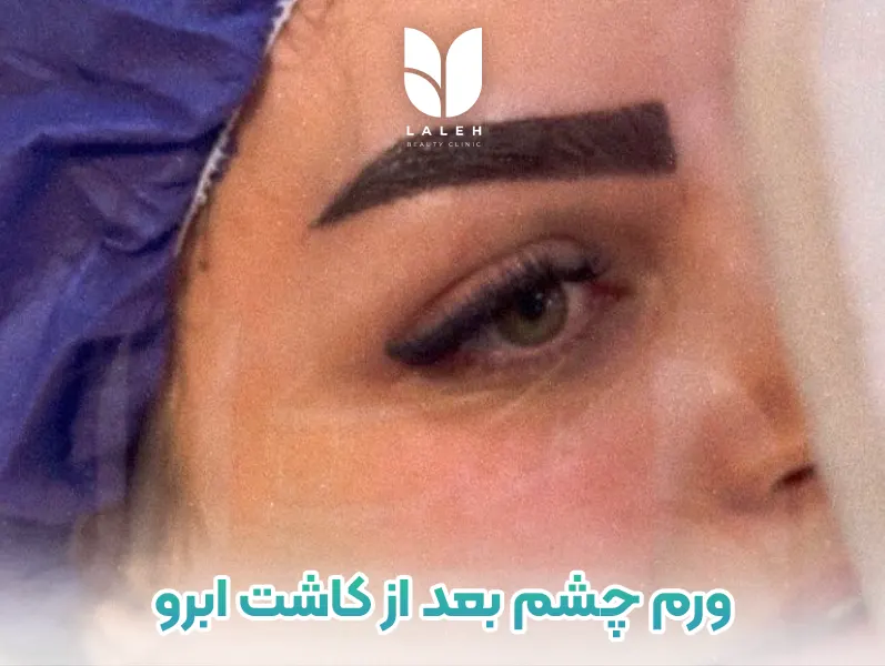 کبودی و ورم چشم بعد از کاشت ابرو