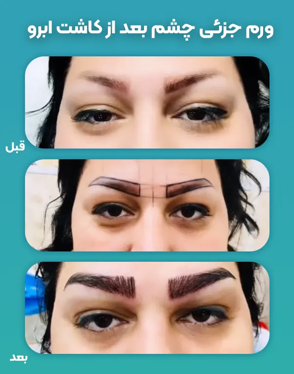 کبودی و ورم چشم بعد از کاشت ابرو