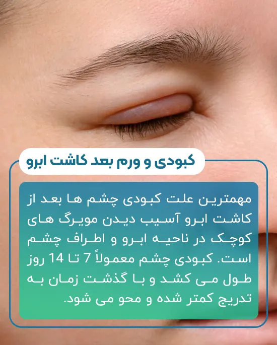کبودی و ورم چشم بعد از کاشت ابرو