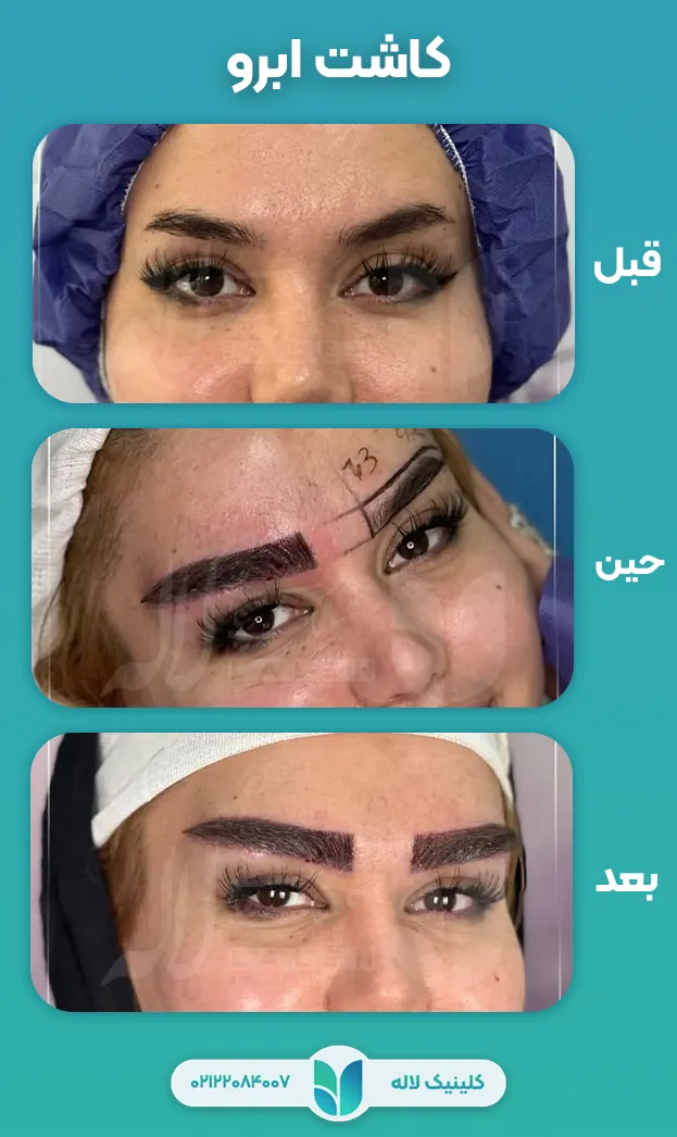 قبل و بعد کاشت ابرو