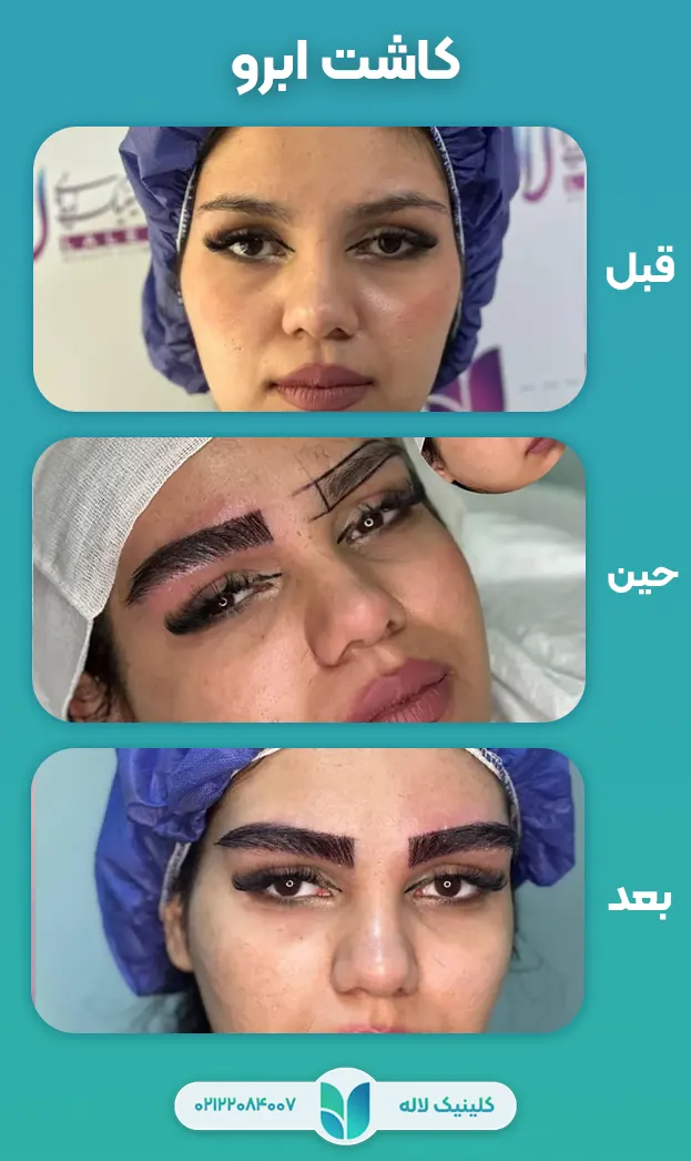 قبل و بعد کاشت ابرو