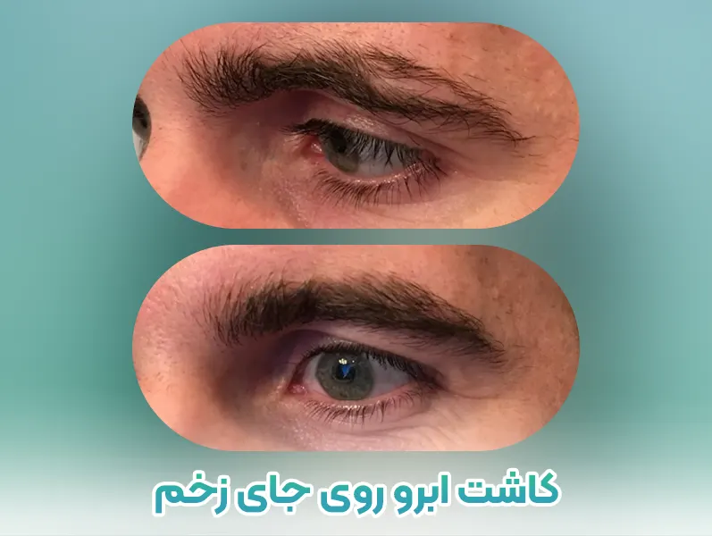 کاشت ابرو روی جای زخم