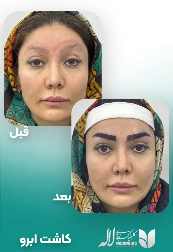 کاشت ابرو روی اسکار