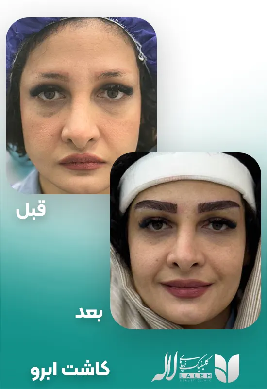 کاشت ابرو لاله