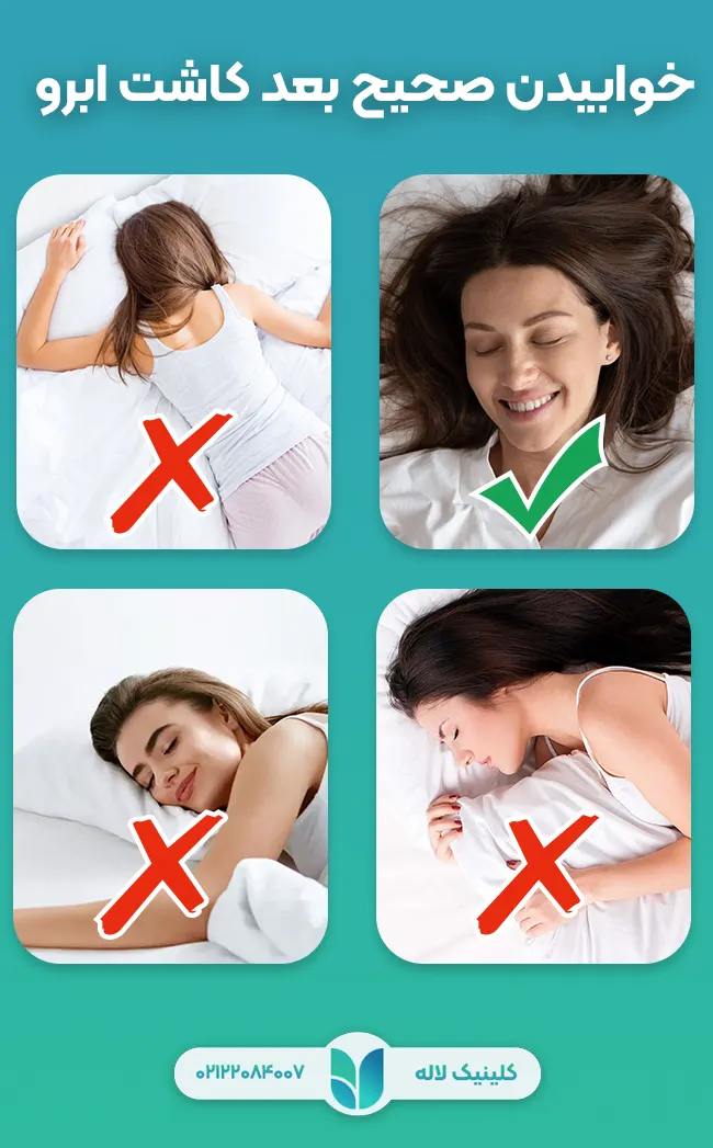 نحوه خوابیدن بعد از کاشت