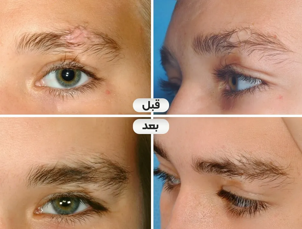 کاشت ابرو روی جای زخم