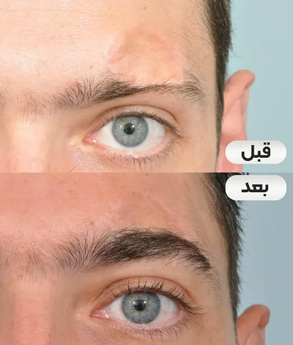 کاشت ابرو روی جای زخم