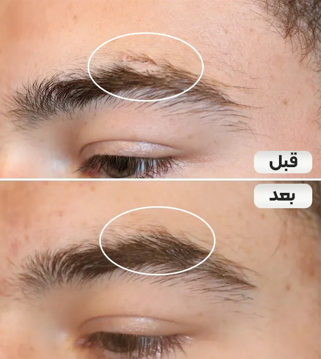 کاشت ابرو روی اسکار ابرو