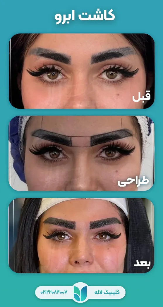 قبل بعد کاشت ابرو