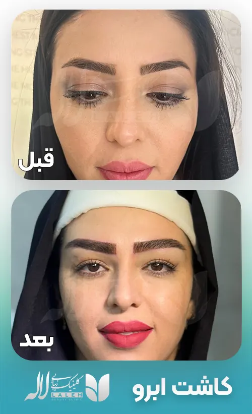 کاشت ابرو دخترانه
