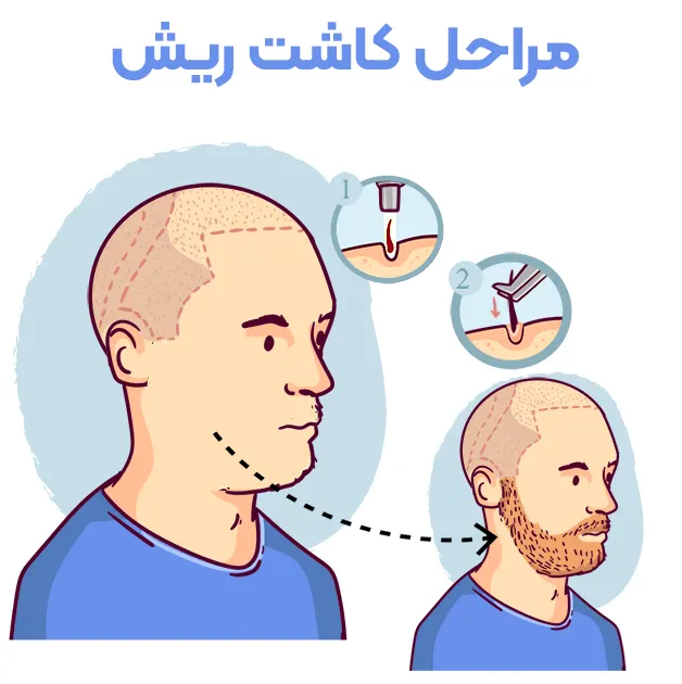 مراحل کاشت ریش و سبیل