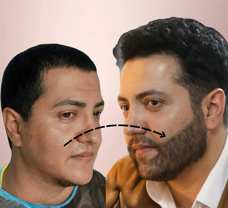 کاشت ریش و سبیل
