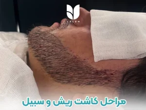 مراحل کاشت ریش و سبیل