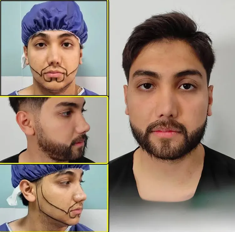 مراحل کاشت ریش و سبیل