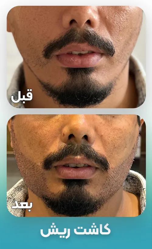 کاشت ریش و سبیل