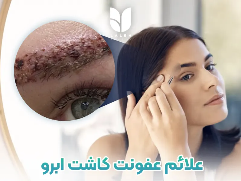 علائم عفونت کاشت ابرو