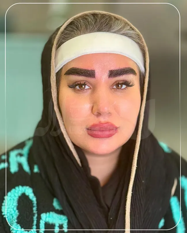 هدبند بعد از کاشت ابرو