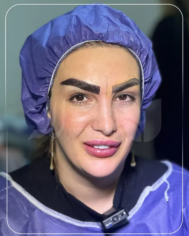 کاشت ابرو
