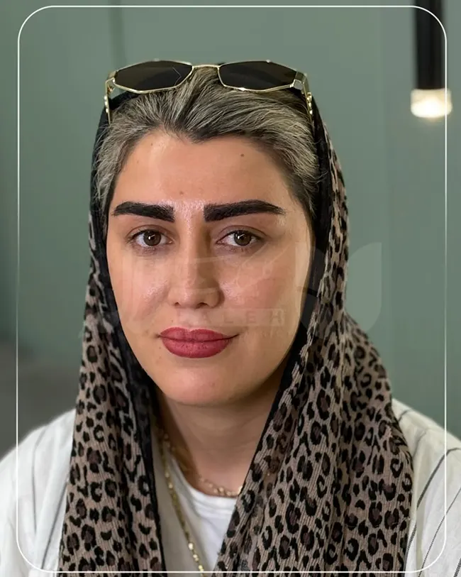 کاشت ابرو لاله