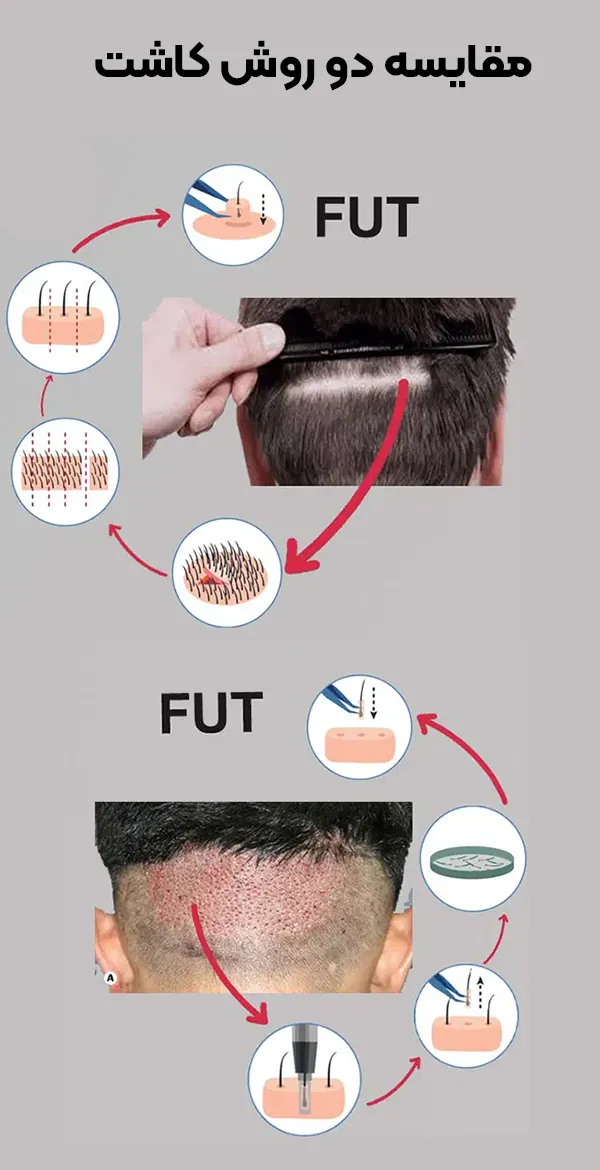 مقایسه کاشت ابرو بدون جراحی و با جراحی