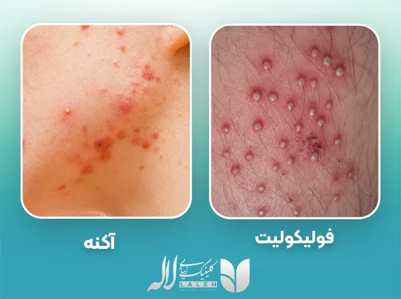 تفاوت فولیکولیت و جوش
