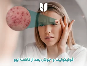 فولیکولیت و جوش بعد از کاشت ابرو