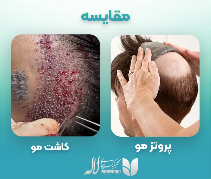 مقایسه کامل کاشت مو با پروتز مو