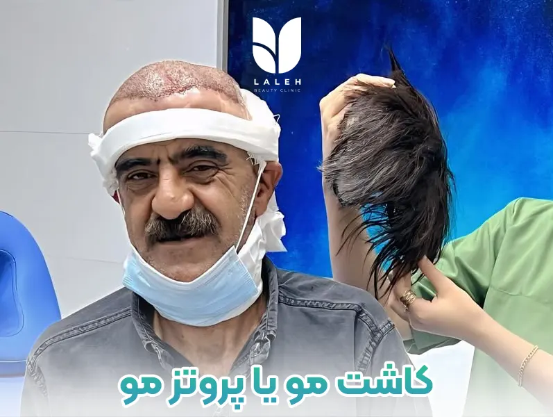 مقایسه کاشت مو یا پروتز مو