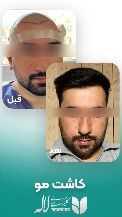 کاشت مو