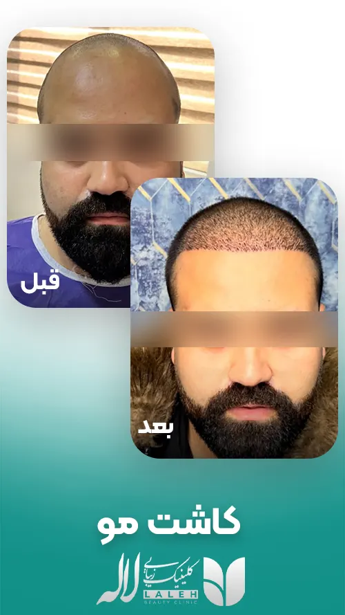 کاشت مو لاله